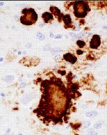 nigral neuron Machado-Joseph's disease -neuronal intranuclear inclusions ataxin-3 in. Mutant ataxin-3, demonstrating that it is distinct from the nucleolus.