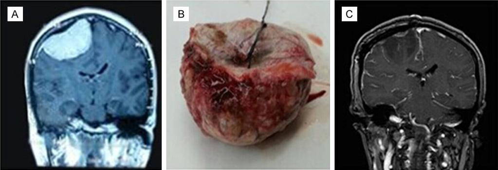 Figure 1. The patient with meningioma underwent Simpson Grade I resection. is a risk factor for atypical and anaplastic meningiomas. Hasseleid et al.