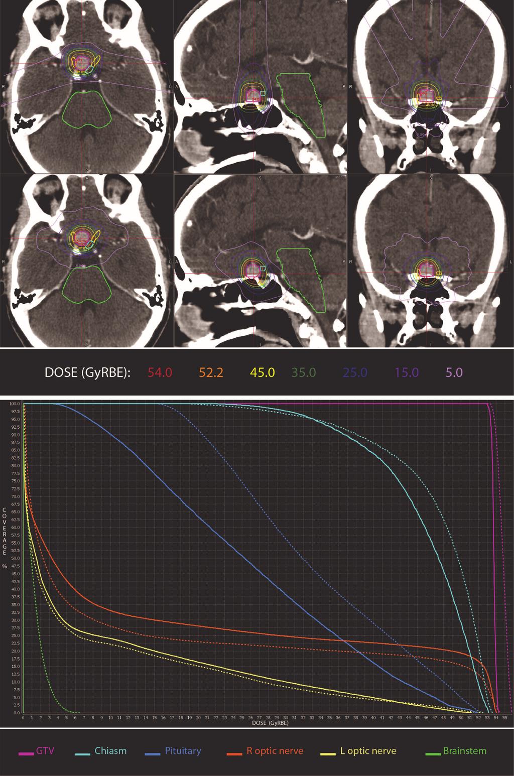 Page 6 of 11 Hwang et al. The role of radiotherapy in the management of high-grade meningiomas Figure 2 Radiation plans for right anterior base of skull atypical meningioma receiving 52.