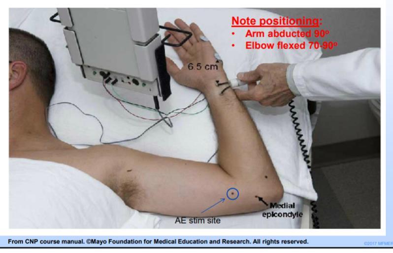 Nerve Conduction Study NCS/EMG 80-90% sensitive if motor and