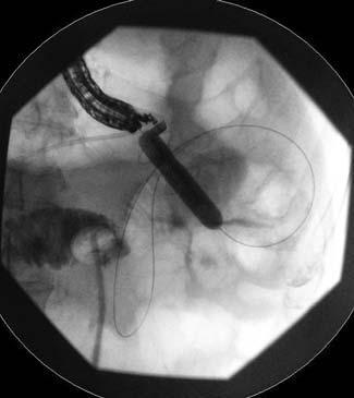 Endoscopic visualization of the needle with the ultra-slim scope confirmed location within the bowel ( " Video ).