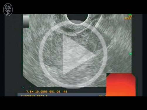 gastrojejunostomy track. Online content including video sequences viewable at: http://dx.doi.org/0.055/s-004-0789 Video Fig.