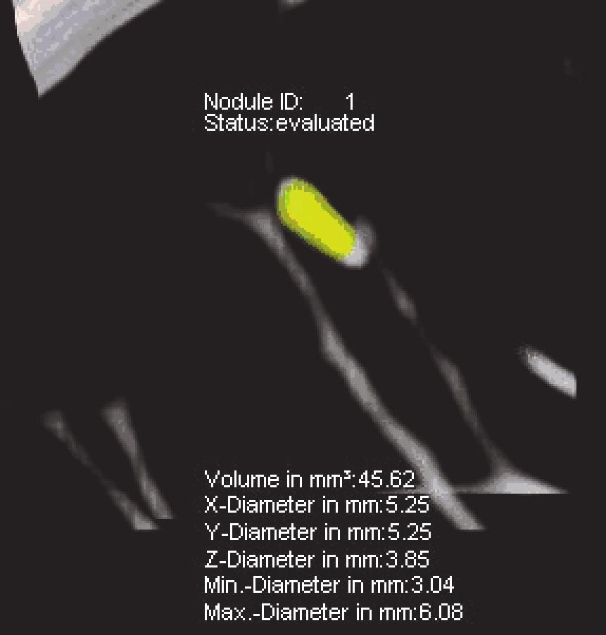 Figure 5 Elongated nodule in which there was incomplete