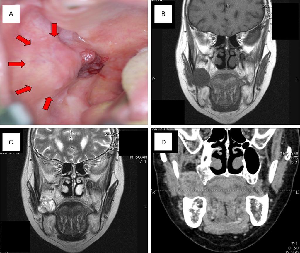 Figure 1. A: Pretreatment intra oral photograph. B: Horizontal T1-weighted magnetic resonance imaging (MRI) scan showing the extent of tumor.