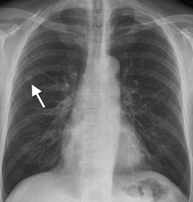 2011;306(17):1865-1873 Screening by Chest