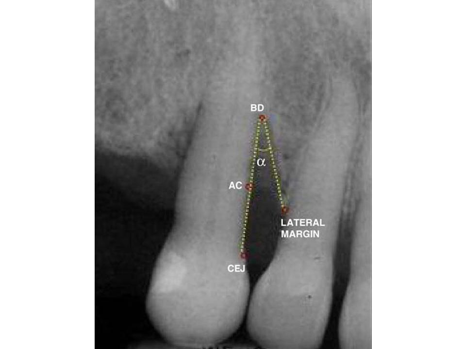 Indirect Digital Radiography in Determining Vertical Bone Loss Esmaeli F et al.