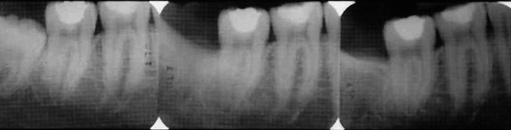 R. Pippi Figure 2. The complete three-radiograph set of one of the studied second molars. Pre-operative x-ray (left); 3-month postoperative x-ray (middle); 12-month post-operative x-ray (right).