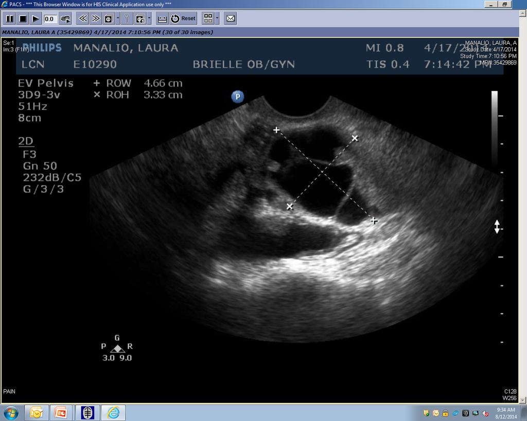 right ovary multiseptated cystic mass with severe nodular thickening CT scan