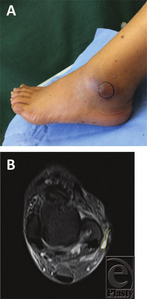 eplasty VOLUME 15 Figure 3. (a) Macroscopic finding showed that the pocket was reduced 10 weeks after the first PRP therapy.