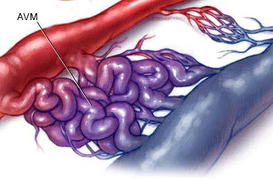 artery Subarachnoid Hemorrhage Arteriovenous Malformations