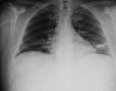 182 Making the Diagnosis between Infection and Acute Alcoholic Hepatitis Sendra et al. Fig. 1 Chest X-ray showing a condensation in the left lower lobe.