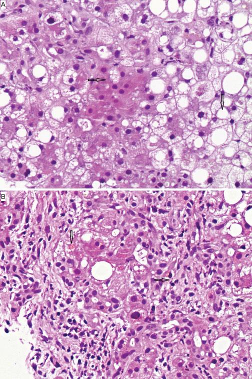 184 Making the Diagnosis between Infection and Acute Alcoholic Hepatitis Sendra et al. Fig. 4 Liver biopsy consistent with acute alcoholic hepatitis.