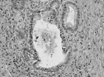Desquamation of necrotized (apoptotic) cells in augmented biliary ducts; trichrome Goldner x200. Fig 14.