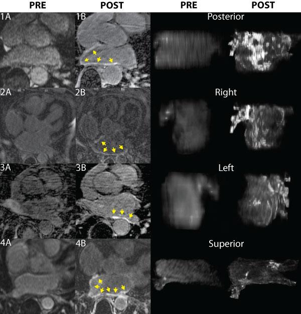 Figure 1. Left atrial injury pre- and 3 months post-pvai on 3D DE-CMRI. Left panels show LA wall slices at baseline (A) and 3 months post (B) PVAI on 3D navigated DE-CMRI in 4 different patients.