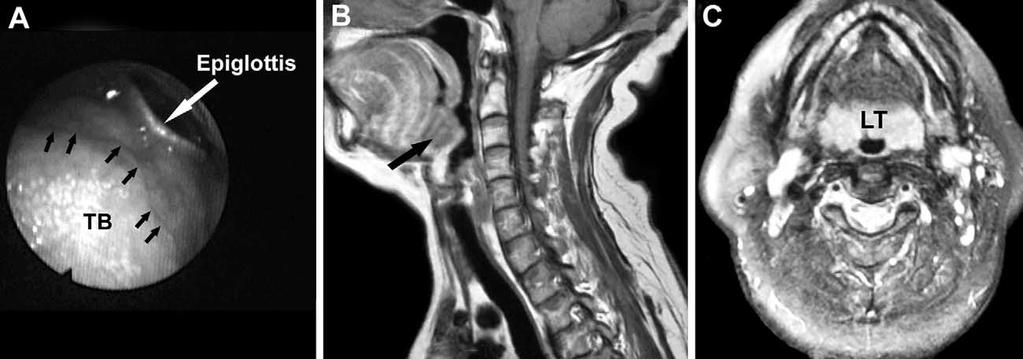 Robinson et al Lingual Tonsillectomy Using Bipolar Radiofrequency... 329 Figure 1 (A) Tonsil and adenoid malleable coblation wand.