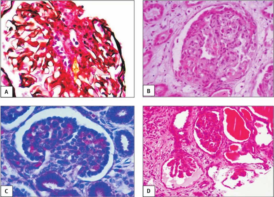 HIV and renal disease in Africa: the journey so far and future directions renal biopsies are routinely performed, different, novel histological patterns of renal disease, associated with HIV, have