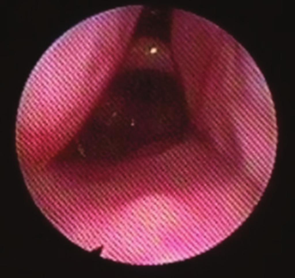 (c) Figure 2: Supraglottic larynx with the pharyngeal tonsils seen laterally.