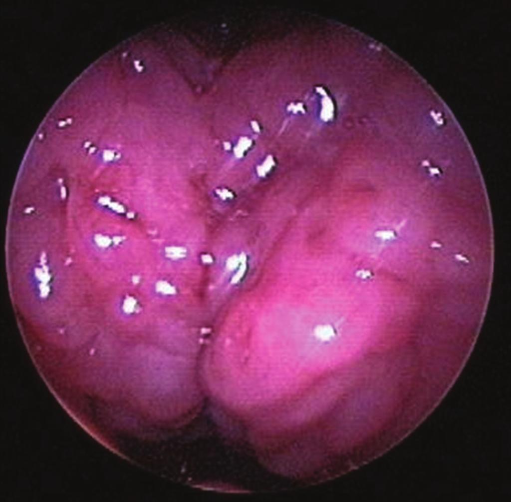 International Journal of Pediatrics 5 Figure 6: Lingual tonsils prior to endoscopic-assisted coblation lingual tonsillectomy. After lingual tonsillectomy, the epiglottis can now be seen.