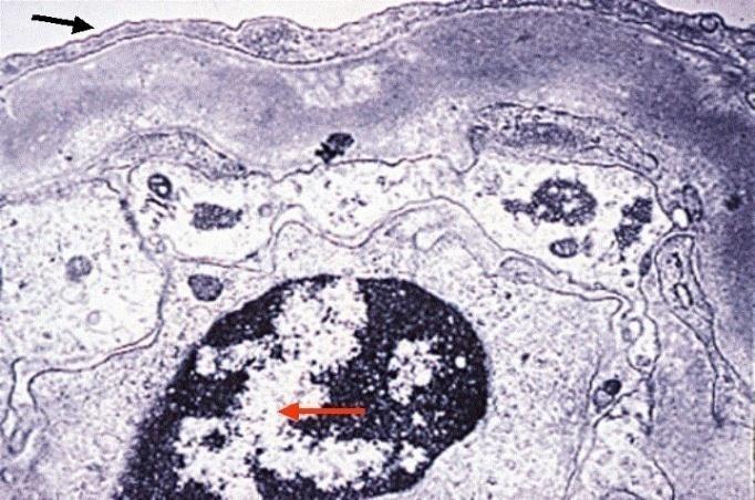of the glomerular basement membrane; foot process effacement (black arrow) and prominent tubuloreticular inclusions (red arrow) are present.