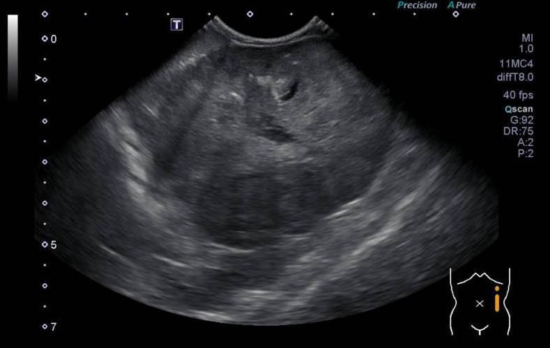 Abdomen Ultrasound Findings: The gallbladder contained suspended and gravity dependent hyperechoic and echogenic debris. There was a heterogeneous, mixed echogenicity mass measuring 6.4 x 4.