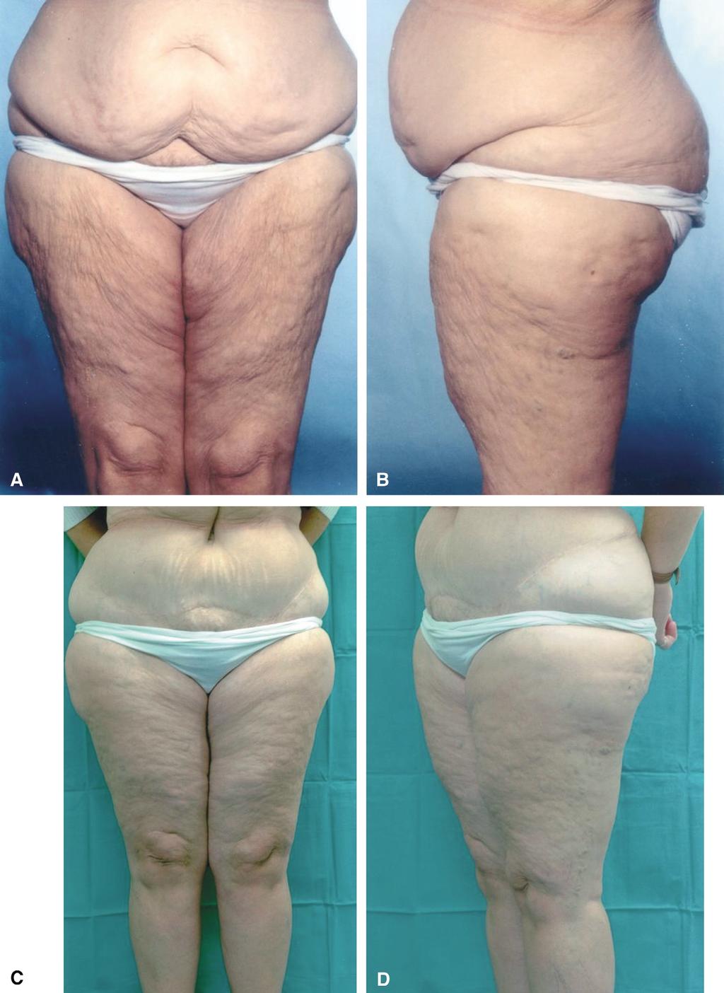 Body contouring by combined abdominoplasty and medial vertical thigh reduction