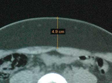 9 cm 1 Mo FU after 3 Tx Treated Area: Abdomen Fat Layer Thick: 3.