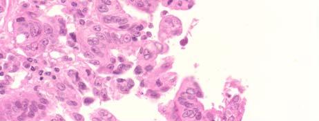 Case 3: IPMN-branch duct type with high-grade dysplasia Case 3: Teaching Points Cytology is the best test for determining cyst grade Distinguishing