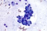 Case 9 Cytological Diagnosis: Satisfactory for Evaluation Negative for