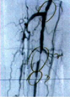 Investigations - Angiography Local anaesthetic Catheter inserted in groin under X-ray