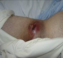 Bleeding from the puncture site Haematoma of groin Migration of closure devise False