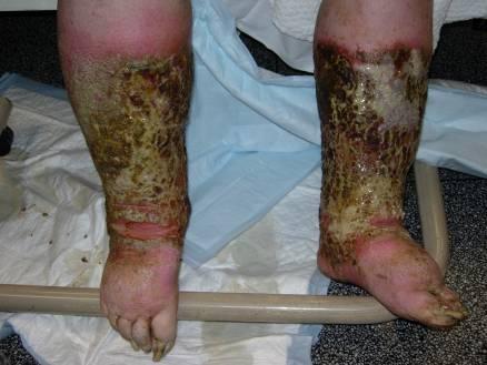 Lower Leg Ulceration A manifestation of underlying pathology/disease process