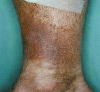 Diagnosis Venous - Ulceration Varicose Veins Venous eczema Skin irritation Eczematous changes, redness, scaling, pruritus Ankle flair Red threads
