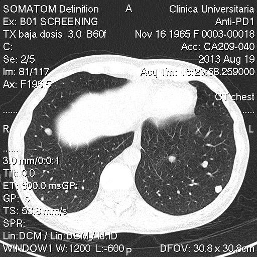 bilateral lung lesions Complete