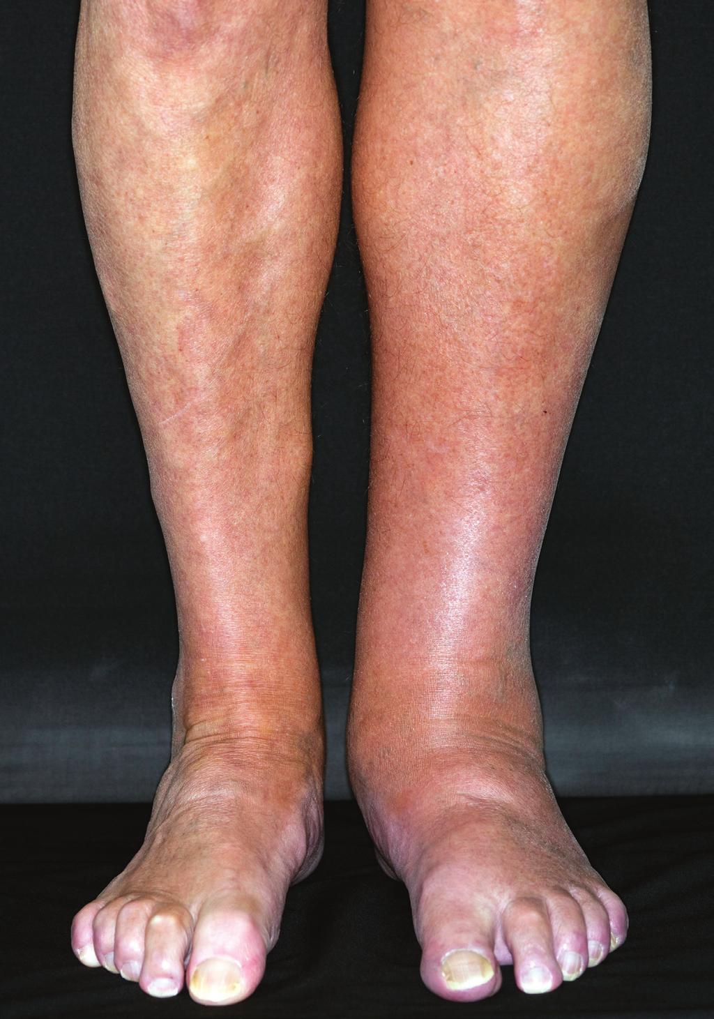 REVIEW Prevention and treatment of venous thromboembolic disease SUSAN McNEILL AND CATHERINE BAGOT Awareness of the risk factors for venous thromboembolic (VTE) disease and timely administration of
