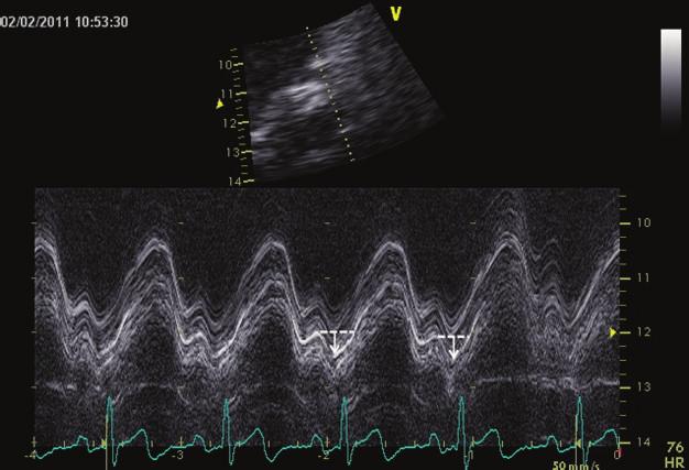 2 Scientifica Figure 1: Representative M-mode tracing showing maximal mitral annular plane systolic motion.
