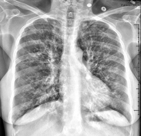 Lung Transplantation Effective treatment for end stage lung disease Shortage of organs High