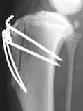 Surgical Management of Patellar Luxation There is always an anatomical problem or deformity involved that allows or causes the patella to luxate, however other factors can contribute.