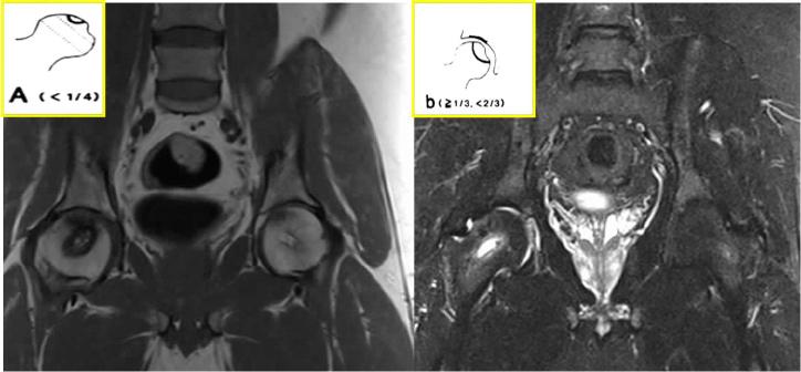 Pre CD T1 weighted MRI (B) Right side Lesion extent is grade A location is grade B and signal intensity is grade β.