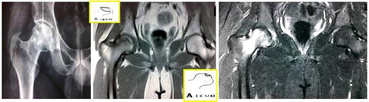 Post CD- T1 weighted (C) and STIR MRI (D) Right side Lesion extent is grade A location is grade C signal intensity is grade γ.