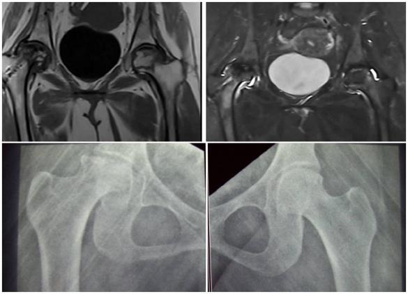 [Table/Fig-9a-f]: (A-C) Pre CD Radiograph (A)shows stage 2 AVN of right hip. Pre CD T1 weighted(b) and STIR (C) MRI shows grade A lesion extent, grade C location and grade α signal intensity.