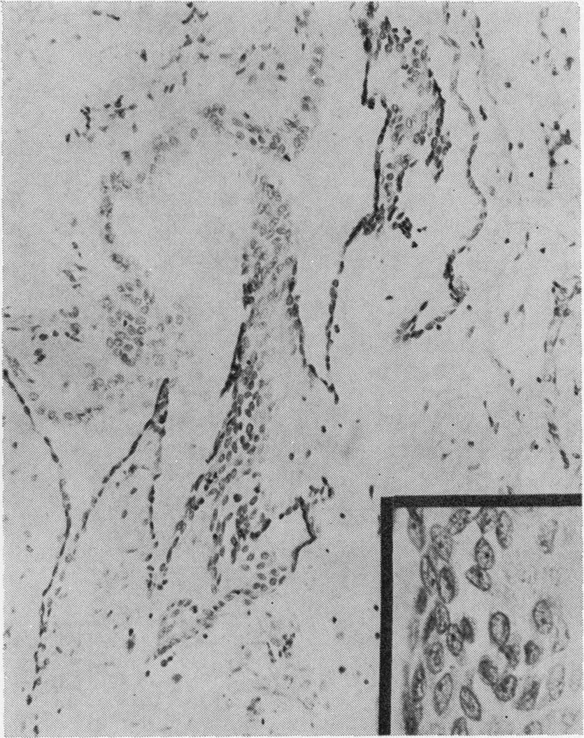 The mesothelium rarely exceeded two layers in thickness even in areas close to fibrous adhesions (fig 4). Multilayering could usually be attributed to histological artefact.