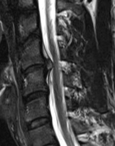 Outcomes from CT-guided Indirect Cervical Nerve Root Blocks disc protrusion disc protrusion