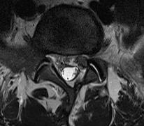 Specific MRI Findings Outcome of Lumbar Spinal Injections
