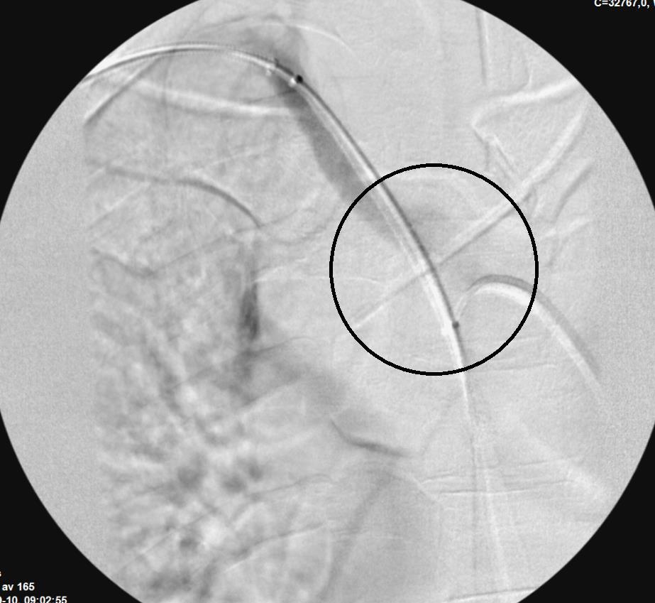Angioplasty balloon inserted from right brachial artery ABO from femoral