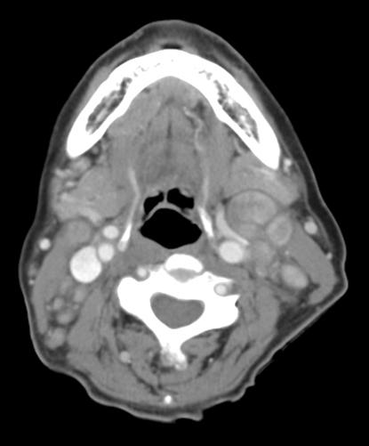 Despite anti-tuberculosis medications for 4 months, the cervical swelling worsened. In addition, she developed a contra-lateral tumor-like mass.