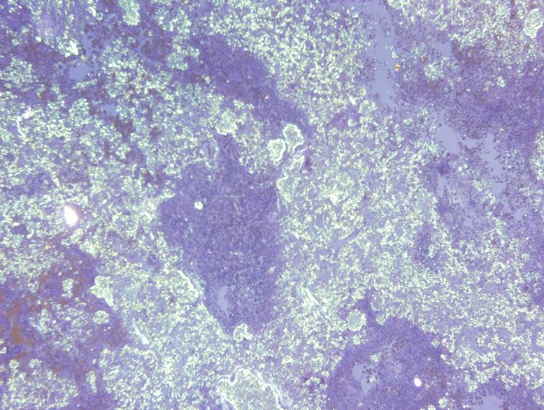 Histopathology of the lymph nodes revealed diffuse amorphous eosinophilic material deposits and chronic inflammation with multinucleated giant cells (Fig. 2).