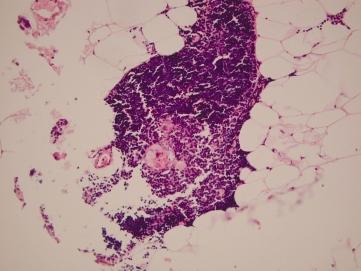 Fig. 1 Histological examination of thymic parenchyma infiltrated with neoplastic cells and composed of proliferating thymic epithelia, and smaller cells that were arranged in an insular pattern.