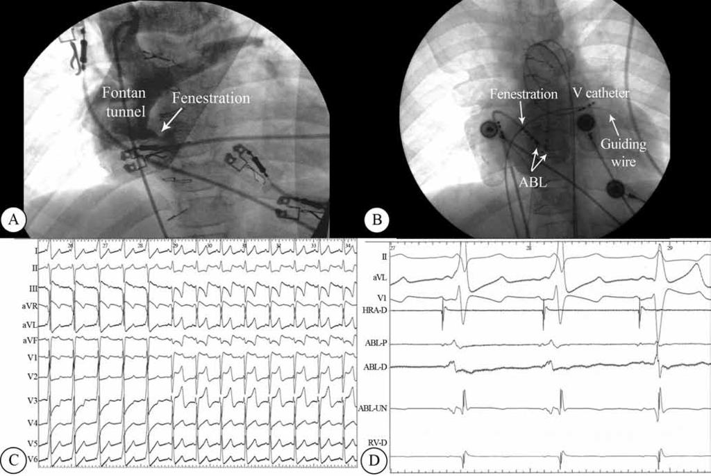 Radiofrequency Ablation of Accessory Pathways in Children with Complex Congenital... TEHRAN HEART CENTER fenestration, atria, and left ventricle, respectively; and 2) via the retrograde aortic approach.