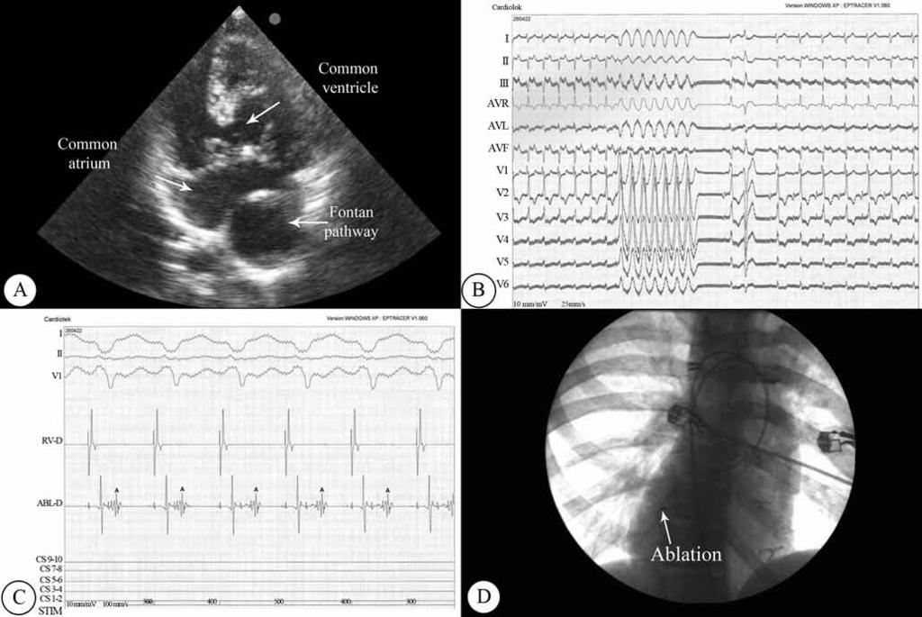 The Journal of Tehran University Heart Center Mohammad Dalili et al. Figure 3. A) Two-dimensional echocardiographic image, depicting the straddling common atrioventricular valve.