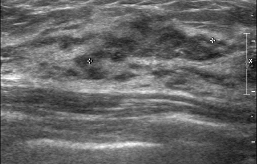 Nariya Cho, et al. A B Fig. 2. A 48-year-old woman with a Breast Imaging Reporting and Data System (BI-RADS) category 3 lesion on supplemental screening ultrasonography. A. Longitudinal B-mode ultrasonogram shows a 25-mm, isoechoic, microlobulated mass (arrows).